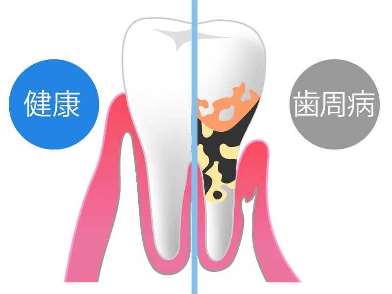 歯周病に気付くポイント